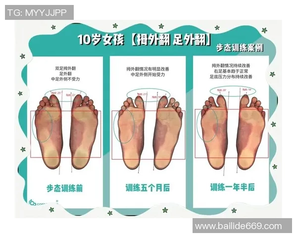 拇外翻困扰足球明星的职业生涯与健康管理探讨 拇外翻困扰足球明星的职业生涯与健康管理探讨